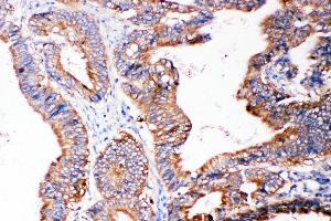 Anti-SMAD5 antibody, IHC(P) IHC(P): Human Intestinal Cancer Tissue (SMAD5 antibody  (Middle Region))