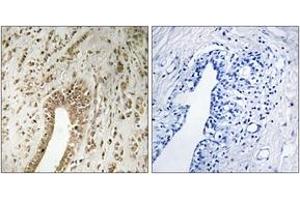Immunohistochemistry analysis of paraffin-embedded human breast carcinoma tissue, using PHF3 Antibody. (PHF3 antibody  (AA 1990-2039))
