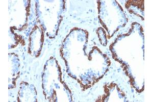 Formalin-fixed, paraffin-embedded human Prostate Carcinoma stained with Cytokeratin 13 Mouse Monoclonal Antibody (KRT13/2213). (Cytokeratin 13 antibody)