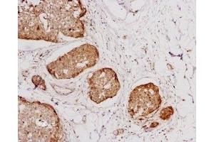 Expression of NTSR1 in human breast cancer - Immunohistochemical staining of human breast cancer cells using Anti-Neurotensin Receptor 1 (extracellular) Antibody (ABIN7043383, ABIN7044767 and ABIN7044768), (1:100). (NTSR1 antibody  (2nd Extracellular Loop))