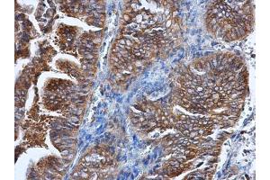 IHC-P Image HPRT antibody detects HPRT protein at cytoplasm in human endometrial cancer by immunohistochemical analysis. (HPRT1 antibody)