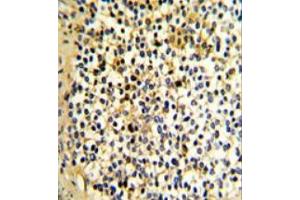 Formalin-Fixed, Paraffin-Embedded Human kidney carcinoma stained with DCXR Antibody (Center) followed which was peroxidase-conjugated to the secondary antibody, followed by DAB staining.