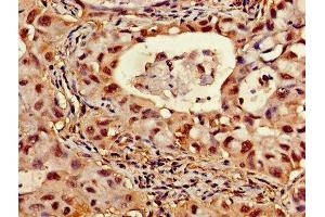 Immunohistochemistry of paraffin-embedded human lung cancer using ABIN7144848 at dilution of 1:100 (ATP5F1D antibody  (AA 23-168))