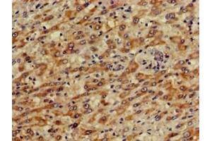 Immunohistochemistry of paraffin-embedded human liver cancer using ABIN7146606 at dilution of 1:100 (PRKACG antibody  (Catalytic Subunit gamma))