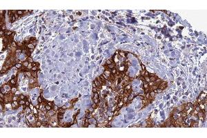 ABIN6277316 at 1/100 staining Human Head and neck cancer tissue by IHC-P. (CLEC4D antibody  (Internal Region))