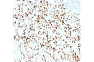 Formalin fixed paraffin embedded human colon carcinoma stained with p21 Rabbit Recombinant Monoclonal Antibody (CIP1/4377R). (Recombinant p21 antibody  (AA 1-100))