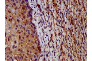 IHC image of ABIN7155245 diluted at 1:200 and staining in paraffin-embedded human lung cancer performed on a Leica BondTM system. (HAL antibody  (AA 36-152))
