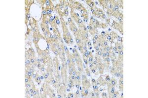Immunohistochemistry of paraffin-embedded human liver injury using UQCRC2 antibody at dilution of 1:100 (x40 lens).