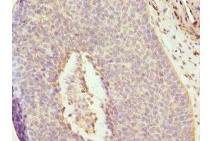 Immunohistochemistry of paraffin-embedded human cervical cancer using ABIN7150033 at dilution of 1:100 (DAAM2 antibody  (AA 1-86))