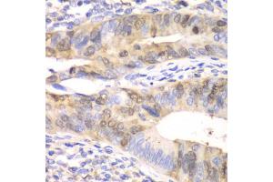 Immunohistochemistry of paraffin-embedded human colon carcinoma using UBE2C antibody (ABIN5973207) at dilution of 1/100 (40x lens). (UBE2C antibody)