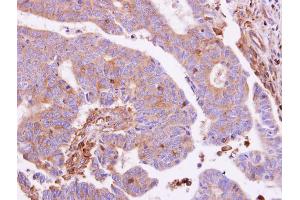 IHC-P Image G protein alpha Inhibitor 1 antibody detects GNAI1 protein at cytoplasm on human colon carcinoma by immunohistochemical analysis. (GNAI1 antibody  (Center))