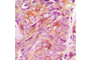 Immunohistochemical analysis of GRASP55 staining in human breast cancer formalin fixed paraffin embedded tissue section. (GORASP2 antibody  (Center))