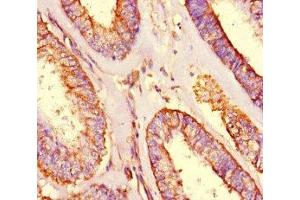 Immunohistochemistry of paraffin-embedded human endometrial cancer using ABIN7166128 at dilution of 1:100 (SHROOM3 antibody  (AA 1309-1571))