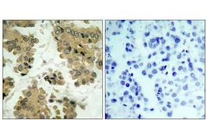 Immunohistochemical analysis of paraffin-embedded human lung carcinoma tissue using Akt2 (Ab-474) antibody (E021155). (AKT2 antibody)