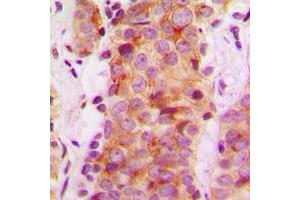 Immunohistochemical analysis of Rabaptin 5 beta staining in human breast cancer formalin fixed paraffin embedded tissue section. (RABEP2 antibody  (Center))