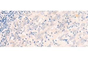 Immunohistochemistry of paraffin-embedded Human cervical cancer tissue using EME2 Polyclonal Antibody at dilution of 1:40(x200) (EME2 antibody)