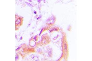 Immunohistochemical analysis of AMPK beta 1 (pS182) staining in human lung cancer formalin fixed paraffin embedded tissue section. (PRKAB1 antibody  (pSer182))