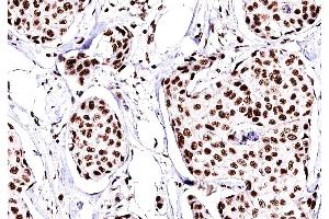 ABIN6269094 at 1/200 staining human Breast cancer tissue sections by IHC-P. (C-JUN antibody  (N-Term))