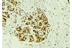 ABIN6277540 at 1/100 staining Human breast cancer tissue by IHC-P. (NEK2 antibody  (Internal Region))