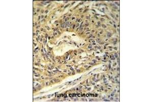 ATP5A1 Antibody (C-term) (ABIN653734 and ABIN2843039) IHC analysis in formalin fixed and paraffin embedded lung carcinoma followed by peroxidase conjugation of the secondary antibody and DAB staining. (ATP5A1 antibody  (C-Term))