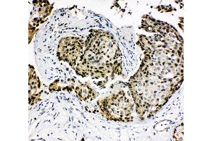 Anti-HOXA4 antibody, IHC(P) IHC(P): Human Mammary Cancer Tissue (HOXA4 antibody  (N-Term))