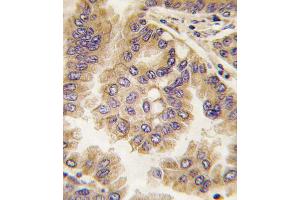 Formalin-fixed and paraffin-embedded human lung carcinoma tissue reacted with GJA5 antibody (N-term), which was peroxidase-conjugated to the secondary antibody, followed by DAB staining. (Cx40/GJA5 antibody  (N-Term))