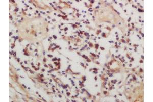 Formalin-fixed and paraffin embedded human lung carcinoma labeled with Rabbit Anti-CSK (Ser364) Polyclonal Antibody, Unconjugated  at 1:200 followed by conjugation to the secondary antibody and DAB staining (CSK antibody  (pSer364))