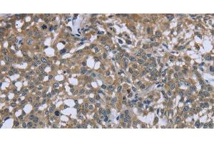 Immunohistochemistry of paraffin-embedded Human cervical cancer using PTK2B Polyclonal Antibody at dilution of 1:50 (PTK2B antibody)