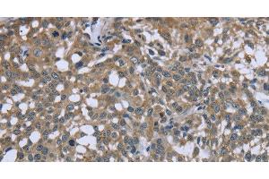 Immunohistochemistry of paraffin-embedded Human cervical cancer using PTK2B Polyclonal Antibody at dilution of 1:50 (PTK2B antibody)
