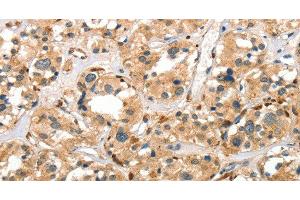 Immunohistochemistry of paraffin-embedded Human thyroid cancer using Cathepsin E Polyclonal Antibody at dilution of 1:40 (Cathepsin E antibody)