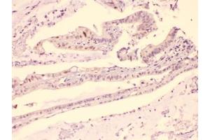 IHC testing of FFPE human intestinal carcinoma with HDGF antibody at 1ug/ml.