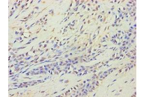 Immunohistochemistry of paraffin-embedded human breast cancer using ABIN7164537 at dilution of 1:100 (HARS2 antibody  (AA 34-506))