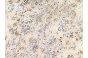 ABIN6255002 and ABIN6266460 at 1/100 staining human melanoma by IHC-P. (PAK3 antibody  (pSer154))