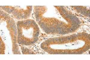 Immunohistochemistry of paraffin-embedded Human colon cancer using AKR1B1 Polyclonal Antibody at dilution of 1:30 (AKR1B1 antibody)