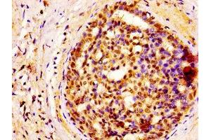 IHC image of ABIN7152118 diluted at 1:400 and staining in paraffin-embedded human breast cancer performed on a Leica BondTM system. (GSPT1 antibody  (AA 6-142))