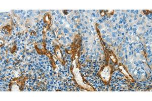 Immunohistochemistry of paraffin-embedded Human cervical cancer using CAV1 Polyclonal Antibody at dilution of 1:40 (Caveolin-1 antibody)