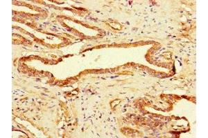 Immunohistochemistry of paraffin-embedded human prostate cancer using ABIN7158768 at dilution of 1:100