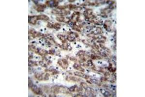 Immunohistochemistry analysis in formalin fixed and paraffin embedded human liver tissue reacted with GCD / GCDH Antibody (C-term) followed by peroxidase conjugation of the secondary antibody and DAB staining.