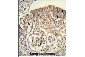 Formalin-fixed and paraffin-embedded human lung carcinoma reacted with PLTP Antibody (C-term), which was peroxidase-conjugated to the secondary antibody, followed by DAB staining. (PLTP antibody  (C-Term))