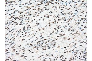 Immunohistochemical staining of paraffin-embedded Adenocarcinoma of colon tissue using anti-SSBmouse monoclonal antibody. (SSB antibody)