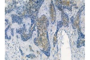ABIN7093817 and ABIN7097860 at 1/100 staining human breast carcinoma by IHC-P. (CXCL2 antibody  (C-Term))