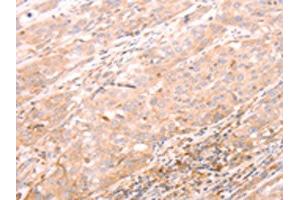 The image on the left is immunohistochemistry of paraffin-embedded Human esophagus cancer tissue using ABIN7189783(ALPPL2 Antibody) at dilution 1/20, on the right is treated with synthetic peptide. (ALPPL2 antibody)
