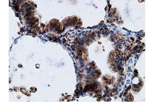 Immunohistochemical staining of paraffin-embedded Adenocarcinoma of Human breast tissue using anti-KHK mouse monoclonal antibody.