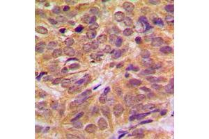 Immunohistochemical analysis of FOXO4 (pS197) staining in human breast cancer formalin fixed paraffin embedded tissue section. (FOXO4 antibody  (pSer197))