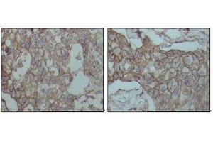 Immunohistochemical analysis of paraffin-embedded human breast carcinoma tissues, showing membrane localization with DAB staining using CD44 antibody. (CD44 antibody)