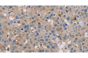 Immunohistochemistry of paraffin-embedded Human breast cancer using CLIC1 Polyclonal Antibody at dilution of 1:30 (CLIC1 antibody)