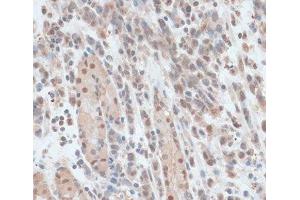 Immunohistochemistry of paraffin-embedded Human gastric cancer using ZNF562 Polyclonal Antibody at dilution of 1:100 (40x lens). (ZNF562 antibody)