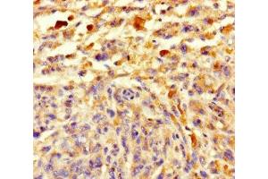 Immunohistochemistry of paraffin-embedded human melanoma using ABIN7148108 at dilution of 1:100 (C12ORF68 antibody  (AA 1-194))
