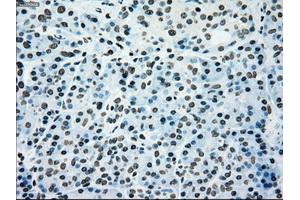 Immunohistochemical staining of paraffin-embedded Adenocarcinoma of colon tissue using anti-SILV mouse monoclonal antibody. (Melanoma gp100 antibody)
