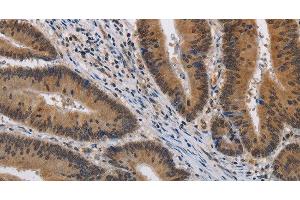 Immunohistochemistry of paraffin-embedded Human colon cancer using KCNG4 Polyclonal Antibody at dilution of 1:40 (KCNG4 antibody)